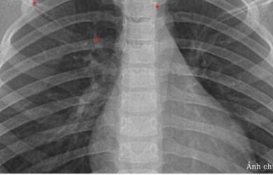 Bé trai 3 tuổi nhập viện gấp do tự điều trị cúm B tại nhà